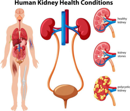 Human Kidney Diseases 