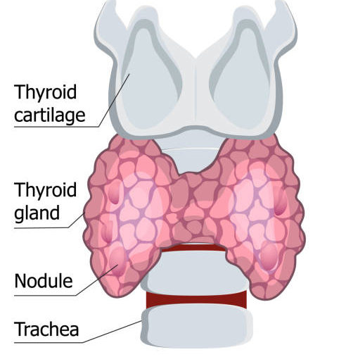 Thyroid treatment at Patna, Noida and Delhi-NCR. Best doctor.Cancer ...