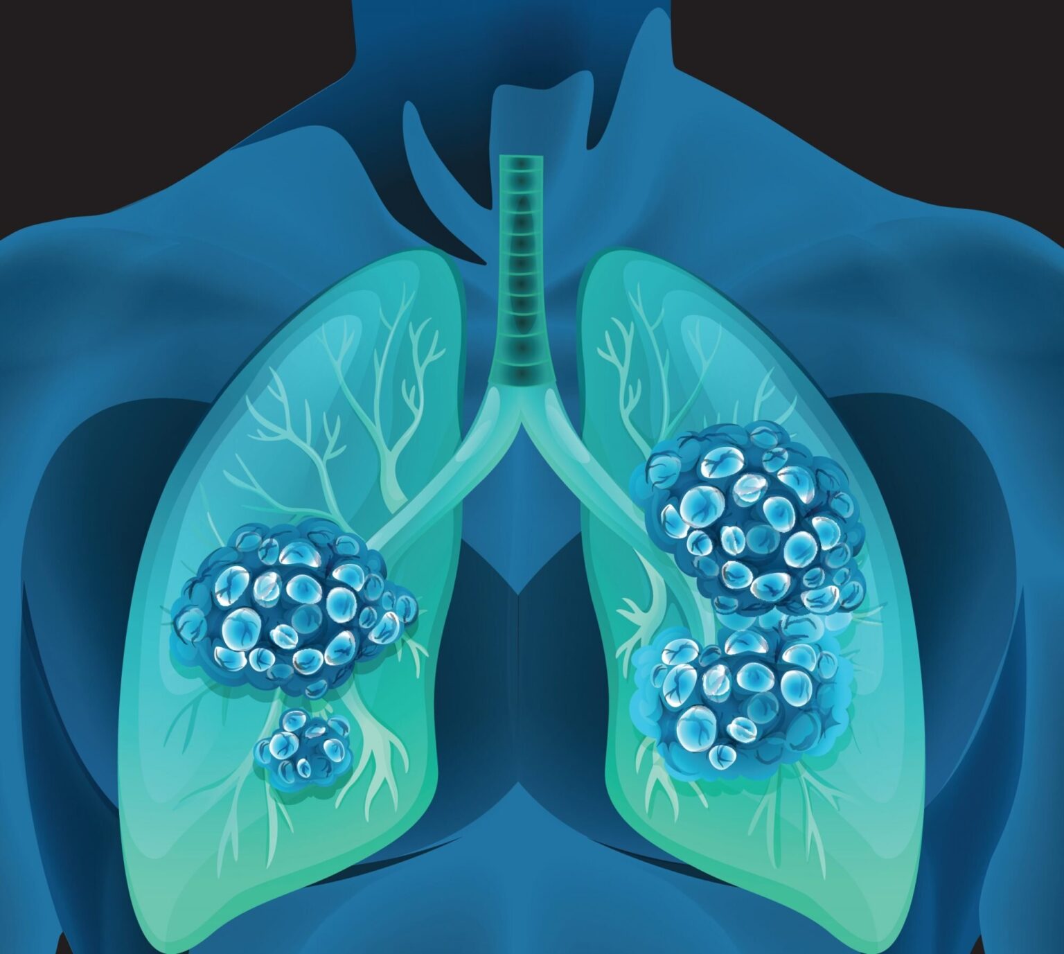 lung-cancer-treatment-centre-by-homeopathy-medicine-noida-patnacancer